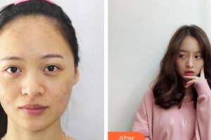 上海天美醫(yī)療美容醫(yī)院秦易見整形價格表附面部吸脂瘦臉案例展示