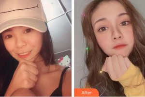 上海普瑞眼科醫(yī)院周靜整形價(jià)格表附全切雙眼皮案例展示