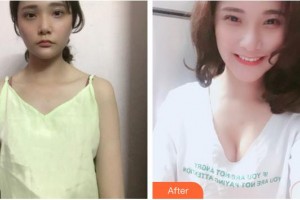 成都美容整形醫(yī)院賴明忠整形價(jià)格表附復(fù)合隆胸案例展示