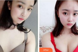 成都醫(yī)美整形美容醫(yī)院王顯榮整形價(jià)格表附濃縮豐胸真實(shí)案例展示