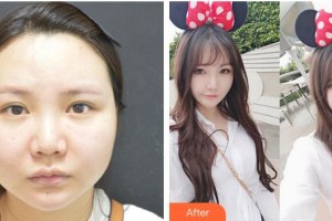 成都少城醫(yī)院醫(yī)療美容科姜元景（KANG WON KYUNG）教授整形價(jià)格表附面部輪廓案例展示