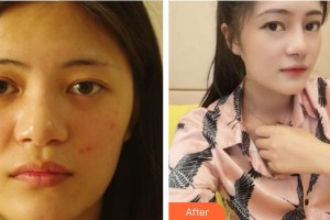 成都美雅娜醫(yī)療美容門診部廖連平整形價(jià)格表附鼻部整形案例展示