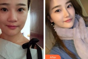 成都美容整形醫(yī)院賈徳淵整形價(jià)格表附耳軟骨復(fù)合隆鼻案例展示