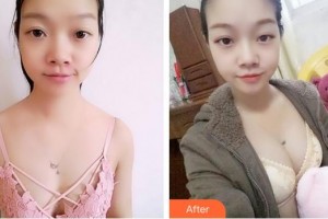 成都美容整形醫(yī)院劉來(lái)新整形價(jià)格表附濃縮豐胸真實(shí)案例展示
