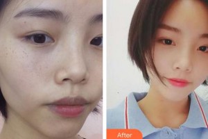 成都晶膚醫(yī)學美容醫(yī)院趙一謙整形價格表附祛雀斑案例展示