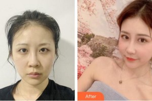 成都唯羅納醫(yī)療美容門診部高海燕整形價格表附鼻部手術案例展示