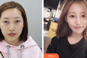 成都西區(qū)醫(yī)院醫(yī)學美容科鄧東偉整形價格表附埋線雙眼皮+鼻部手術(shù)案例展示