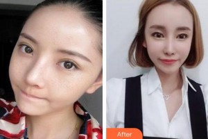 成都潤(rùn)禾皮膚病專(zhuān)科醫(yī)院殷明坤整形價(jià)格表附祛斑案例展示