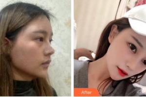 成都安莎貝拉醫(yī)療美容門(mén)診部周順波整形價(jià)格表附鼻部綜合案例展示