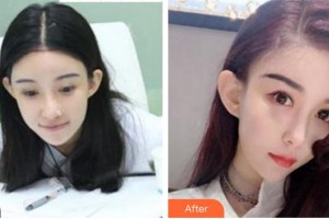 成都瑞麗詩(shī)美學(xué)植發(fā)門(mén)診部姜印整形價(jià)格表附發(fā)際線(xiàn)案例展示