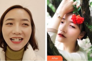 成都茁悅口腔診所童心整形價格表附牙齒矯正案例展示