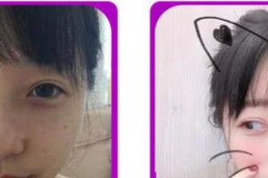 成都愛迪眼科醫(yī)院何順華整形價(jià)格表附雙眼皮切開案例展示