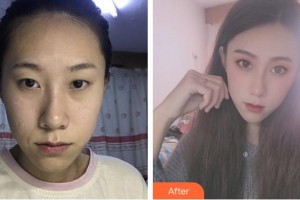 成都愛迪眼科醫(yī)院劉鵬飛整形價(jià)格表附眼部整形案例展示