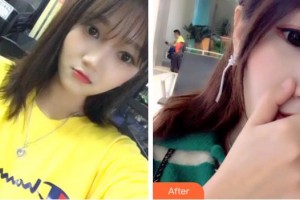 成都純?？谇辉\所劉純虎整形價格表附超聲波潔牙案例展示