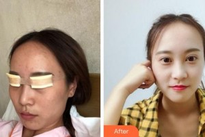 成都中醫(yī)大銀海眼科醫(yī)院謝艾芮整形價(jià)格表附眼部手術(shù)案例展示