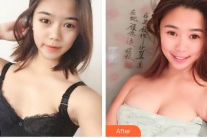 福州曙光整形美容醫(yī)院馮光珍整形價(jià)格表附濃縮豐胸真實(shí)案例展示