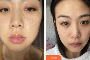 福州美貝爾醫(yī)療美容門診部姚文華整形價(jià)格表附超激光美膚祛斑案例展示