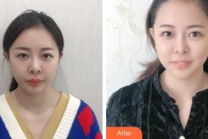 福州海峽美容醫(yī)院藍(lán)紹梓整形價(jià)格表附激光美膚激光祛黑眼圈案例展示