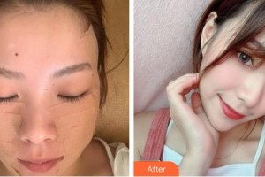 福州市第一醫(yī)院整形美容科楊青青整形價(jià)格表附“6D埋線提升”重返年輕案例展示