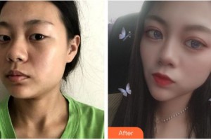 福州臺江醫(yī)院整形美容中心馬美洲整形價(jià)格表附眼部綜合案例展示