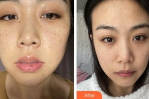 福州秀清醫(yī)療美容診所鐘玉鳳整形價(jià)格表附祛斑案例展示