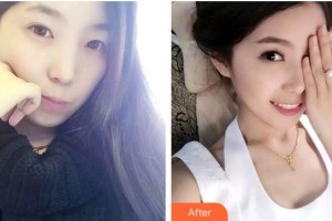 福州美萊華美美容醫(yī)院邱春妹整形價(jià)格表附金屬托槽矯正案例展示