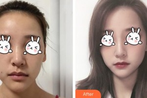 福州美萊華美美容醫(yī)院陳力楊整形價(jià)格表附下巴注射結(jié)合嗨體、線材改良嘟案例展示