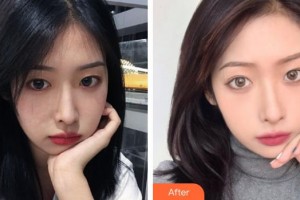 福州臺江醫(yī)院整形美容中心路世敏整形價(jià)格表附熱瑪吉案例展示