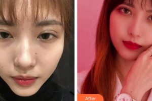 福州海峽美容醫(yī)院隋長青整形價(jià)格表附眼部綜合案例展示