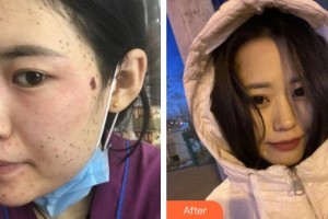 福州愛美爾整形美容醫(yī)院謝楠整形價(jià)格表附超激光美膚祛斑案例展示