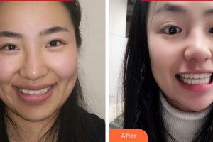 福州維樂口腔門診部郭淑蘋整形價(jià)格表附隱形矯正案例展示