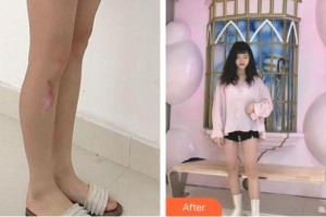 福州愛美爾整形美容醫(yī)院張洪濤整形價(jià)格表附增生疤痕案例展示