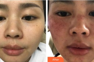 福州愛思特醫(yī)療美容醫(yī)院鄭榕整形價(jià)格表附超激光美膚案例展示