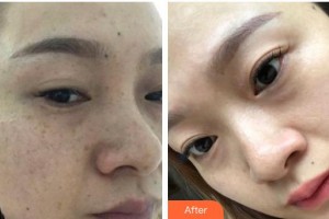 福州臺江醫(yī)院整形美容中心黃富梅整形價(jià)格表附雙激光美膚案例展示