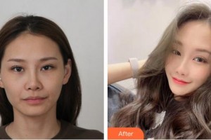 福州名韓整形美容醫(yī)院李陽整形價(jià)格表附DA·面部脂肪填充案例展示