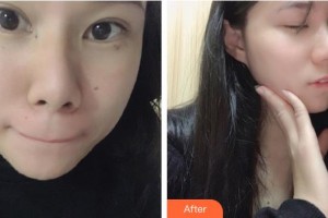 福州愛思特比華利整形美容醫(yī)院嚴(yán)玉秀整形價(jià)格表附雙激光美膚案例展示