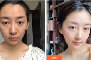 福州美貝爾醫(yī)療美容門診部姍整形價(jià)格表附埋線提升提升案例展示