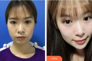 福州市第八人民醫(yī)院整形美容科柴天舉整形價(jià)格表附埋線提升案例展示