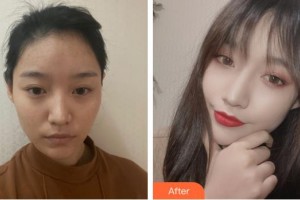 福州市第八人民醫(yī)院整形美容科談偉佳整形價(jià)格表附發(fā)際線種植案例展示