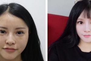 福州海峽美容醫(yī)院李麗強(qiáng)整形價格表附切開雙眼皮案例展示