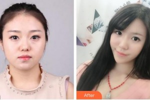 福州格萊美醫(yī)療美容醫(yī)院朱桂香整形價(jià)格表附埋線提升案例展示