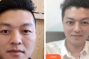 福州美貝爾醫(yī)療美容門診部張曉棠整形價格表附即變男神，無關(guān)痛癢案例展示
