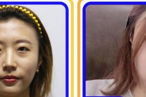 福州格萊美醫(yī)療美容醫(yī)院吳昌炎整形價格表附鼻部手術(shù)案例展示