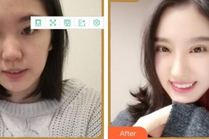 福州眼科醫(yī)院陳大復(fù)整形價格表附眼部手術(shù)案例展示