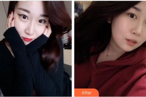 福州眼科醫(yī)院肖韜整形價格表附眼部手術(shù)案例展示