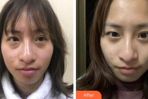 福州東南眼科醫(yī)院夏江勝整形價(jià)格表附不開刀去眼袋+淚溝填充案例展示
