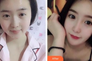 福州東南眼科醫(yī)院趙廣愚整形價(jià)格表附雙眼皮+開(kāi)內(nèi)眼角案例展示
