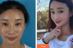 福州東南眼科醫(yī)院莊淑流整形價格表附雙眼皮案例展示