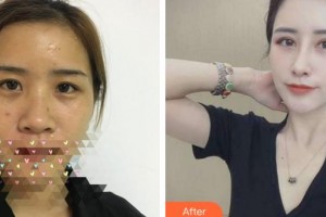 福州東南眼科醫(yī)院陳元整形價(jià)格表附眼部手術(shù)、鼻部手術(shù)，多方面部脂肪填充案例展示