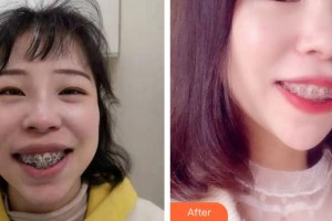 福州維樂(lè)口腔門診部陳獻(xiàn)禮整形價(jià)格表附牙綜合案例展示